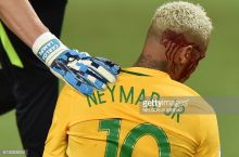 Neymar: Jarohatim jiddiy emas